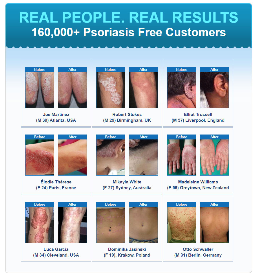 Psoriasis Revolution (TM)~  New Conversion Monster On CB Remedies review image from Supplement Skeptic